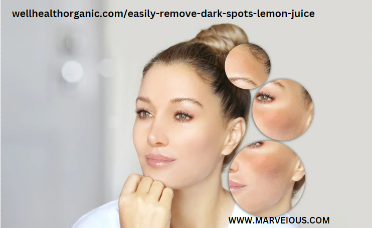 wellhealthorganic.com/easily-remove-dark-spots-lemon-juice